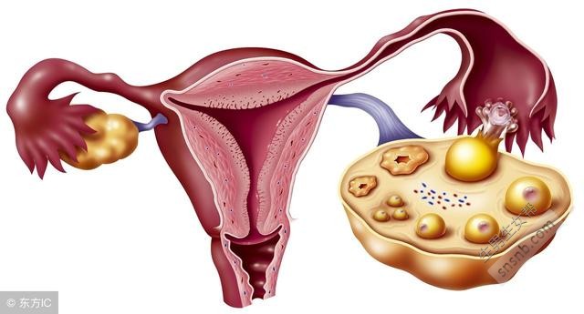 患有多囊卵巢综合症能怀孕吗？如何治疗多囊卵巢综合症？