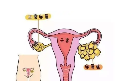 菏泽56岁供卵助孕：怀孕期间卵巢出血的原因是什么？